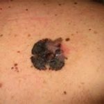 Un'app per scoprire il melanoma