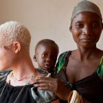 Essere albini in Tanzania