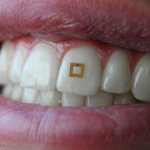 Un sensore sui denti “spierà” ciò che mangiamo