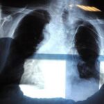 Cancro ai polmoni, individuato il punto debole: è nel 'motore' che lo fa crescere
