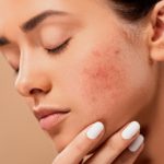I rimedi naturali per sconfiggere l'acne