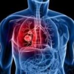 Tumore ai polmoni: un test del sangue per diagnosticarlo. Leggi intervista