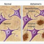 Alzheimer: l’identikit della proteina colpevole