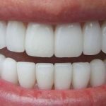 Quattro cibi che mangi ogni giorno e rovinano i denti