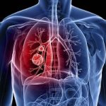 Cancro ai polmoni: ecco i 7 segnali a cui prestare attenzione