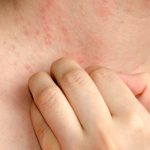 Combattere acne e eczema attraverso gli stessi batteri della pelle che li provocano