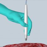 Una «penna» che scova il cancro in 10 secondi