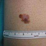 Cancro, oncologo: Tre anni per vaccino mRna contro melanoma