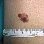 Melanoma, boom nei giovani: è il cancro più comune negli under 30