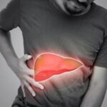 Colangite, l'epatologo: Con acido obeticolico riduzione eventi epatici