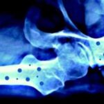 Il 20 ottobre 'Giornata mondiale dell’osteoporosi'